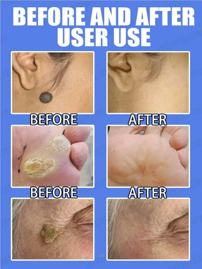 Safe Skin-Friendly Wart Removal Methods – Gentle Solutions for Effective Wart Treatment