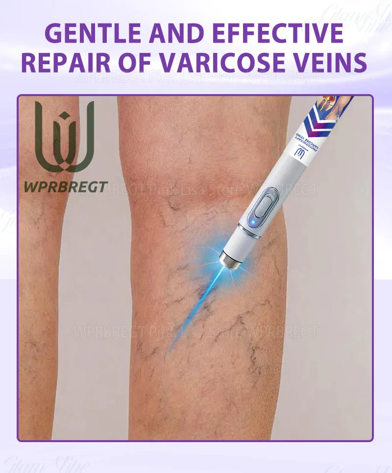 Varicose Vein & Spider Leg Pain Relief Treatment — Painless Care for Vasculitis & Phlebitis