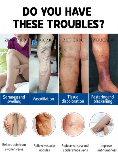 Varicose Vein & Spider Leg Pain Relief Treatment — Painless Care for Vasculitis & Phlebitis