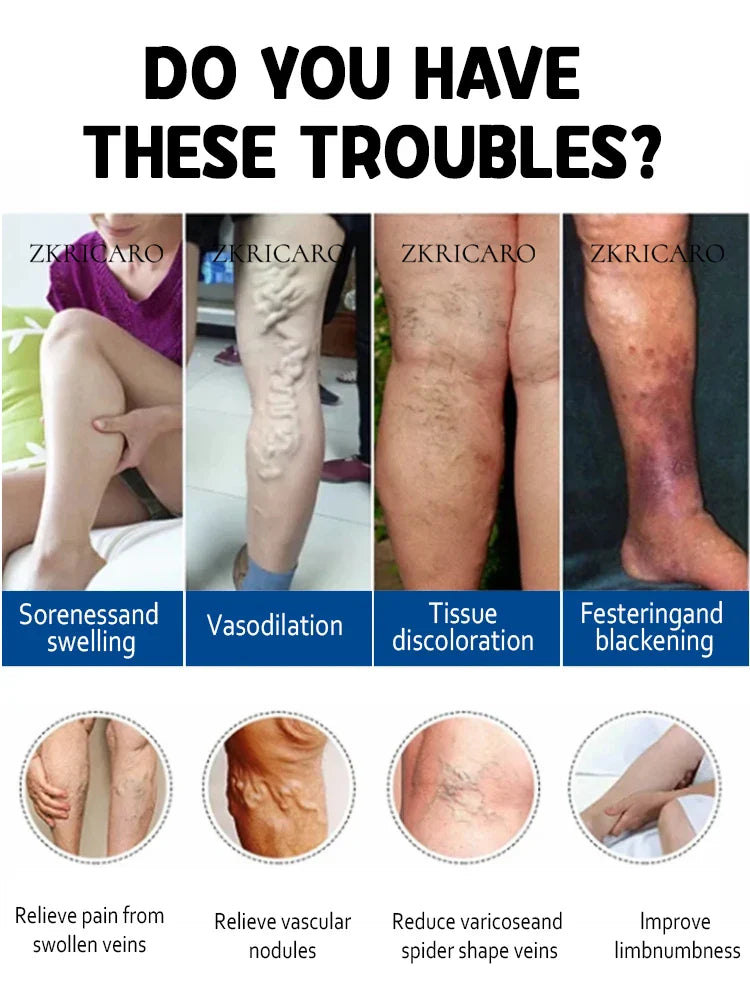 2nd Gen Varicose Vein Laser Therapy Device – Relieves Spider Leg Pain, Treats Vasculitis & Phlebitis