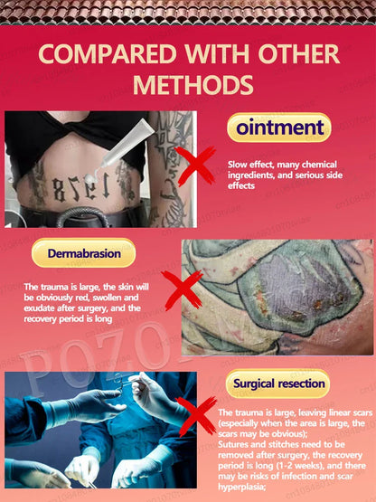 Blue Light Tattoo Removal Pen – Unisex, Suitable for All Ages, Free Shipping