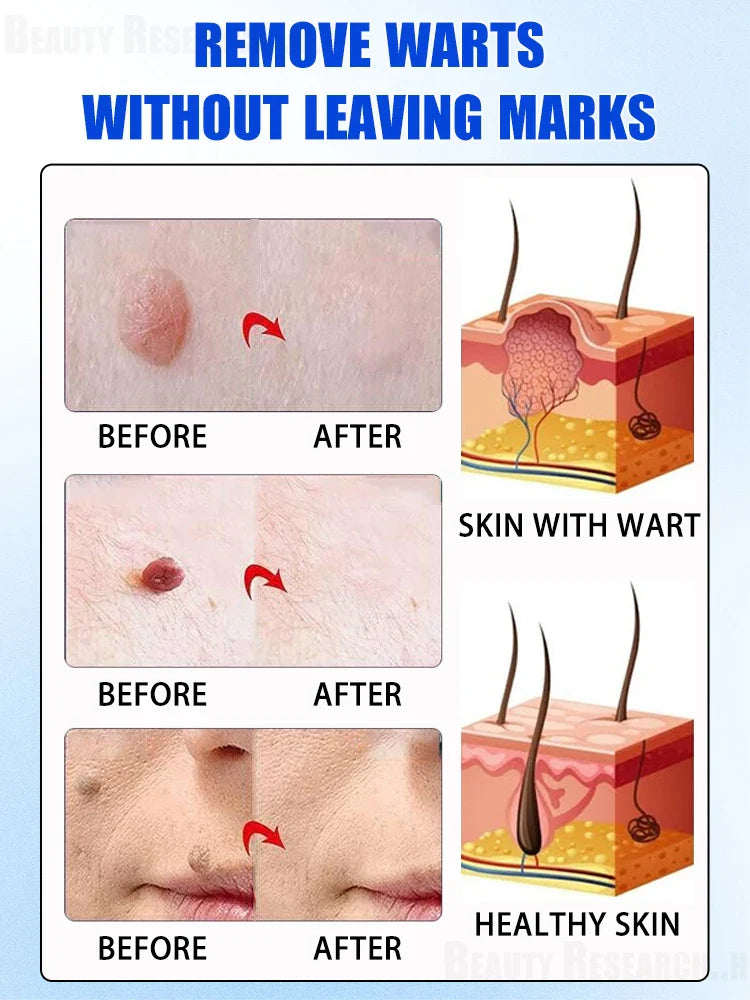 Quick Wart & Sarcoma Removal Treatment – Fast & Effective Skin Care Solution