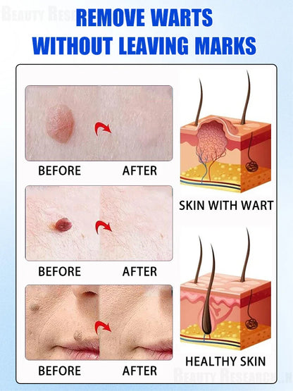 Quick Wart & Sarcoma Removal Treatment – Fast & Effective Skin Care Solution