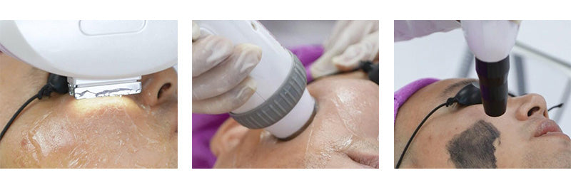 3-in-1 Portable Professional ND YAG & IPL Laser Machine – Hair, Tattoo & Pigment Removal, Skin Rejuvenation