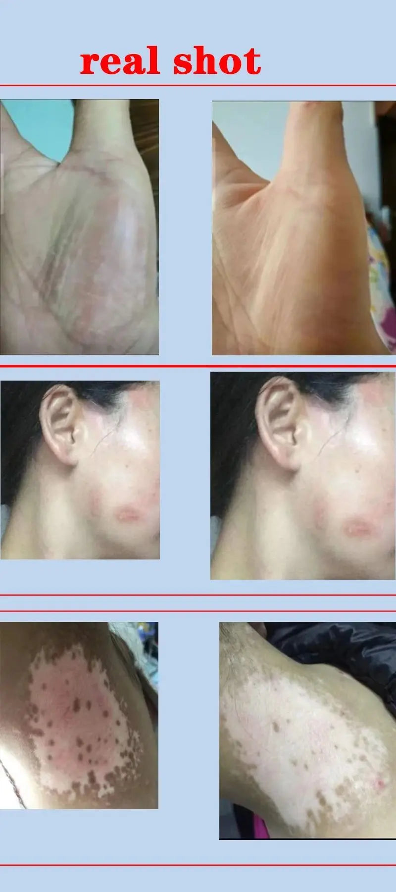 UV 311nm Phototherapy Device – Philips UVB Lamp for Vitiligo, Psoriasis & Skin Treatment