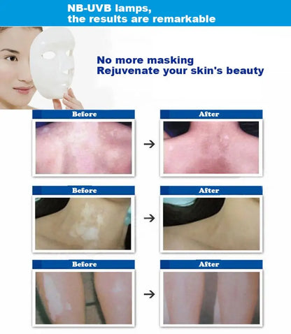 UV 311nm Phototherapy Device – Philips UVB Lamp for Vitiligo, Psoriasis & Skin Treatment