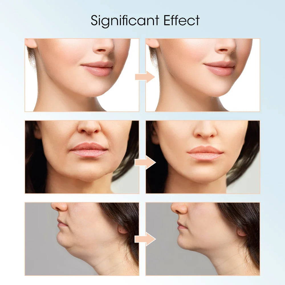 Face Lifting Device with Red Light — V-Face Massager for Double Chin Lift & Skin Rejuvenation, Remote-Controlled Facial Beauty Tool