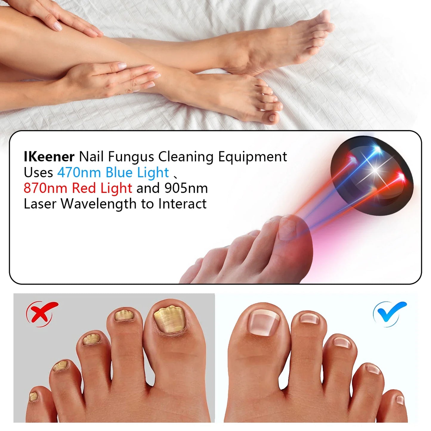 Fast Nail Fungus Repair with Fungal Nail Laser Device - Effective Onychomycosis Treatment
