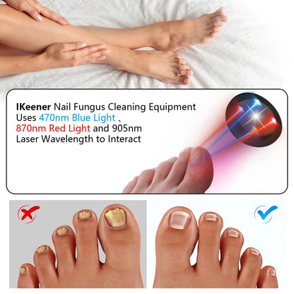 Fast Nail Fungus Repair with Fungal Nail Laser Device - Effective Onychomycosis Treatment
