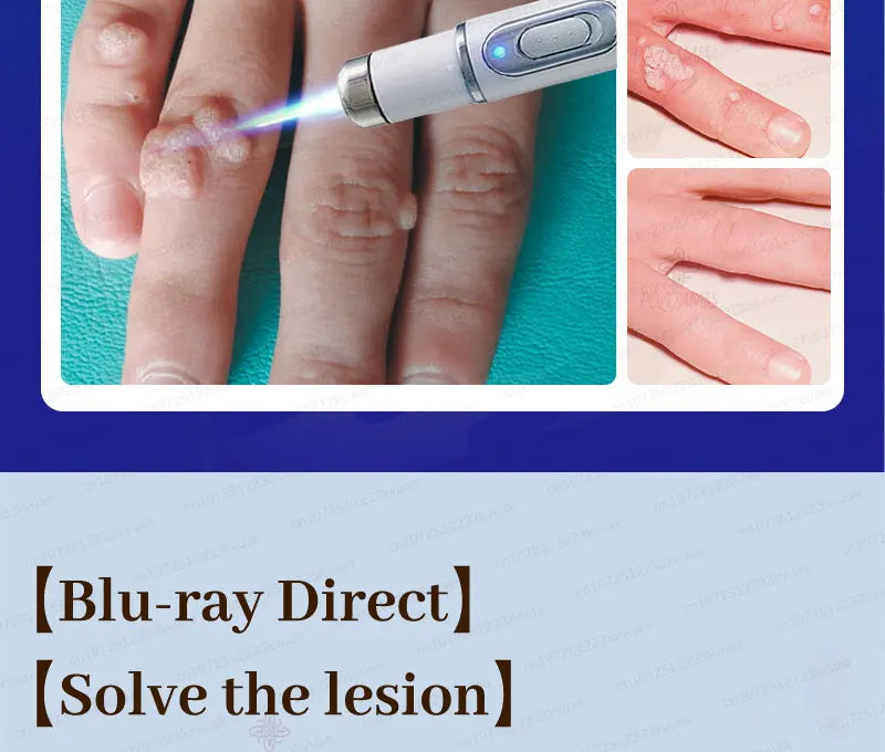 Safe Skin-Friendly Wart Removal Methods – Gentle Solutions for Effective Wart Treatment