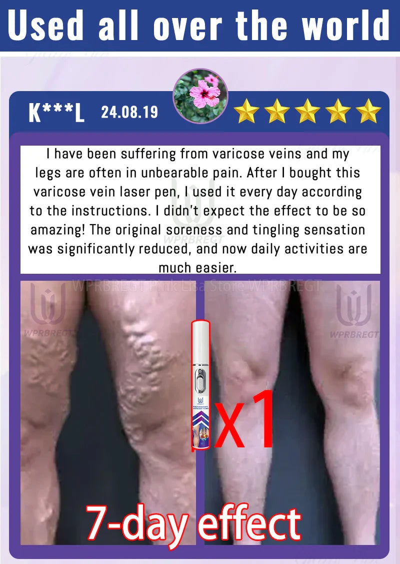 2nd Gen Varicose Vein Laser Therapy Device – Relieves Spider Leg Pain, Treats Vasculitis & Phlebitis